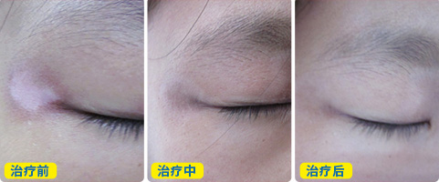 眼角白斑不到一个月能否治好