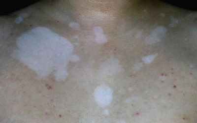 胸前皮肤有一块白色的怎么回事