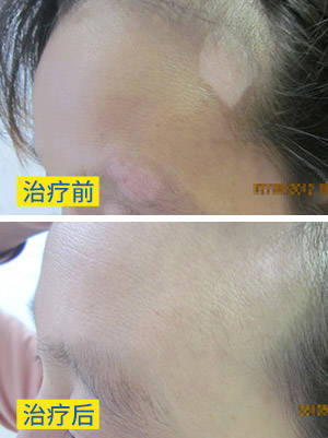 白癜风能治疗好吗 怎么治疗好的快