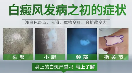 眉毛周围白癜风ZUI初征兆图片