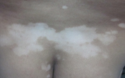 小孩屁股有白色块是什么原因