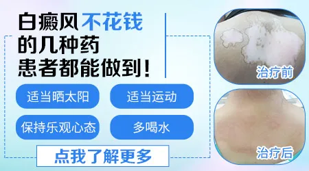 早期一小块白斑大概要花多少钱才能控制住