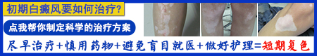 手上长了白癜风近期才长的如何治疗