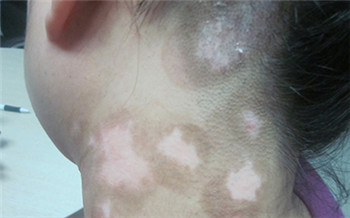 儿童白斑初期症状图片