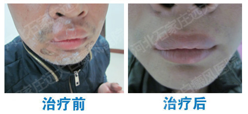 嘴唇白癜风一般多久好 白斑用什么方法治