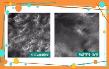 如何区分白癜风的进展期与稳定期