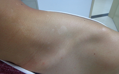 女性肩膀上长了白色的小点点