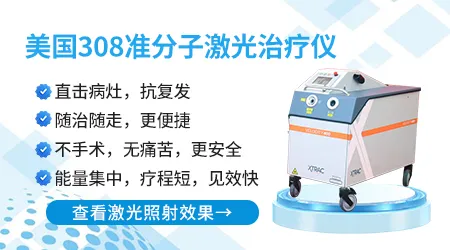 白癜风美国进口308激光照一个光斑多少钱
