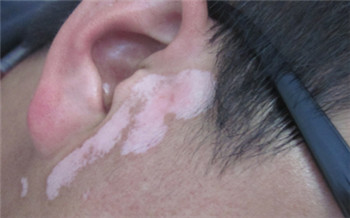 儿童耳朵前边白一块是怎么了