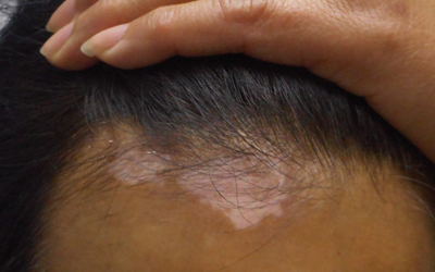 女性额头淡白色白斑怎么治 白斑是白癜风吗