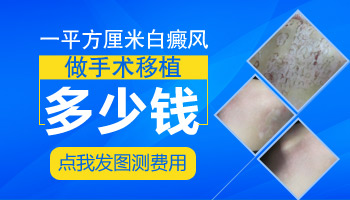 白癜风黑色素种植需要多少钱