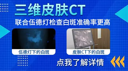 身上白斑和白癜风怎么区分图片
