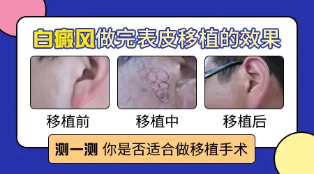 白癜风做移植手术一般多久能复色