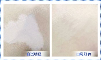 怎么判断自己的白斑有没有恢复