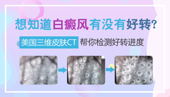 看过白癜风没什么好转是哪里出了问题