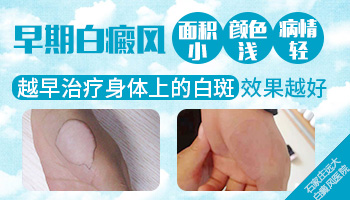 白癜风的哪个部位ZUI好治疗