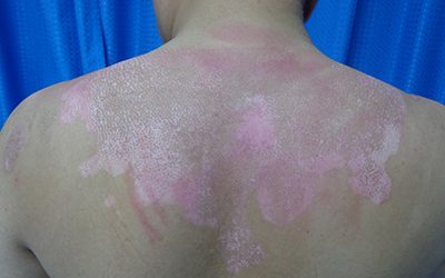 背部白斑早期图片 白斑是什么怎么鉴别