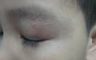 孩子眉尾处有点白是不是白癜风