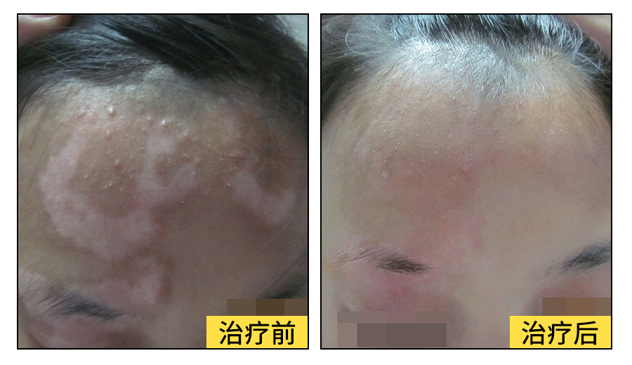 白癜风与自身免疫有关