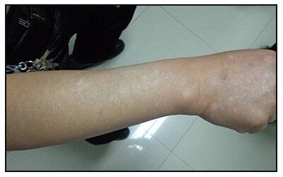 胳膊上有个米粒大小的白斑是什么