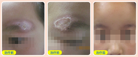 白癜风照光后边缘扩大了怎么回事