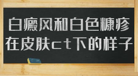 白癜风和白色糠疹在皮肤ct下的样子各有什么不同