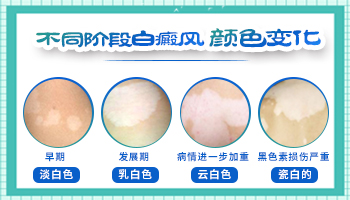 白癜风从开始到变白周期需要多长时间