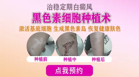 稳定期白斑不治疗一般多久会扩散
