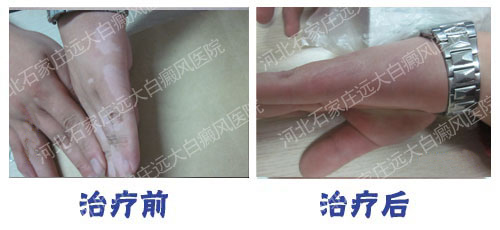 家用308准分子激光灯治疗白癜风怎么样