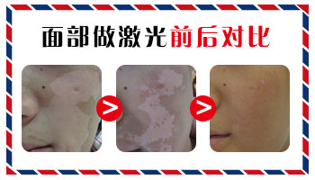 脸两侧耳朵前面都有白癜风怎么治