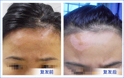 白癜风反复复发是为什么