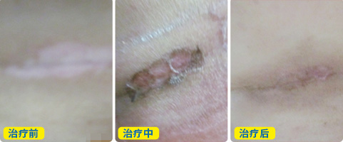 白癜风内缩是什么样的图