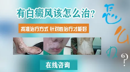 白斑一定要做皮肤CT检查吗