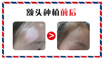 治疗白癜风可以不每次都照激光吗