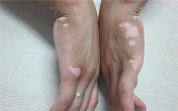 手上有小白点点图片