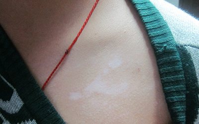 是圆形,方形,线形或点状,其他不规则形状,白斑分布的位置常常是脸上