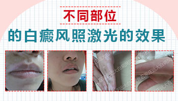 有没有308准分子激光国产机