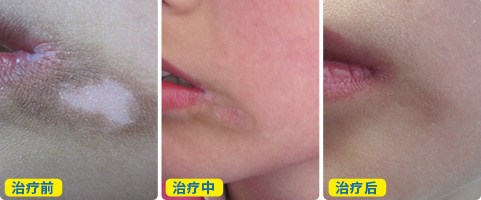 嘴角白癜风治疗一个月了还没好