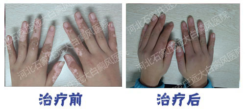 手指白癜风植皮手术后恢复图照片