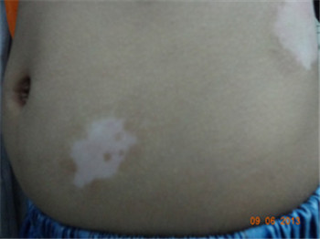 小孩身上有白斑的症状图片