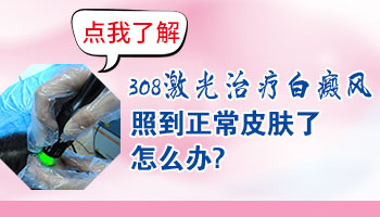 308激光治疗白癜风会刺激到正常皮肤吗