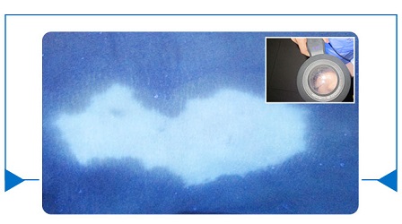 伍德灯下有荧光是什么意思 白癜风在伍德灯下的照片