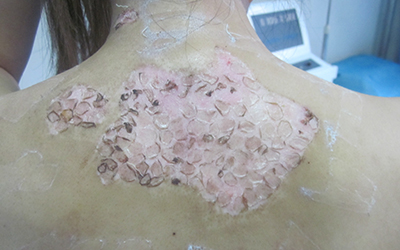 女性背部白癜风植皮的效果图