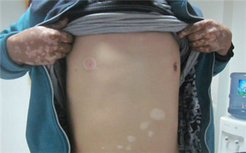 小孩胸前有块白斑以前不明显现在越来越明显