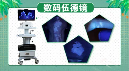 伍德镜能确诊白癜风吗
