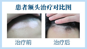 头部白癜风要怎么照光