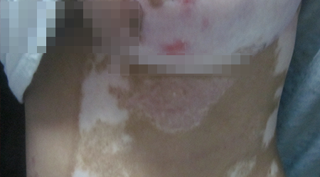 腹部出现白斑是白癜风吗 白癜风的早期图片