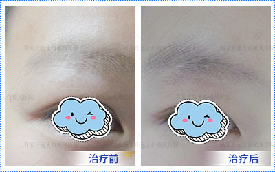 宝宝眼睛周围发白图