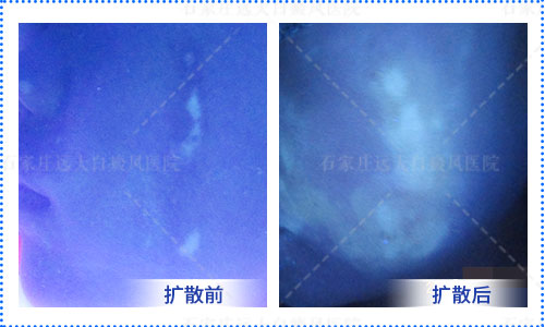 背部和胸部的白癜风扩散特别严重怎么回事