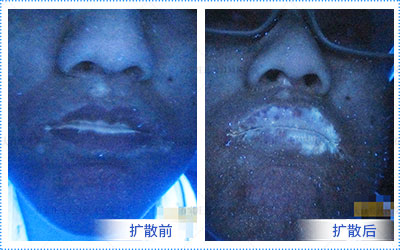 男性脸上的白癜风发展特别快怎么办